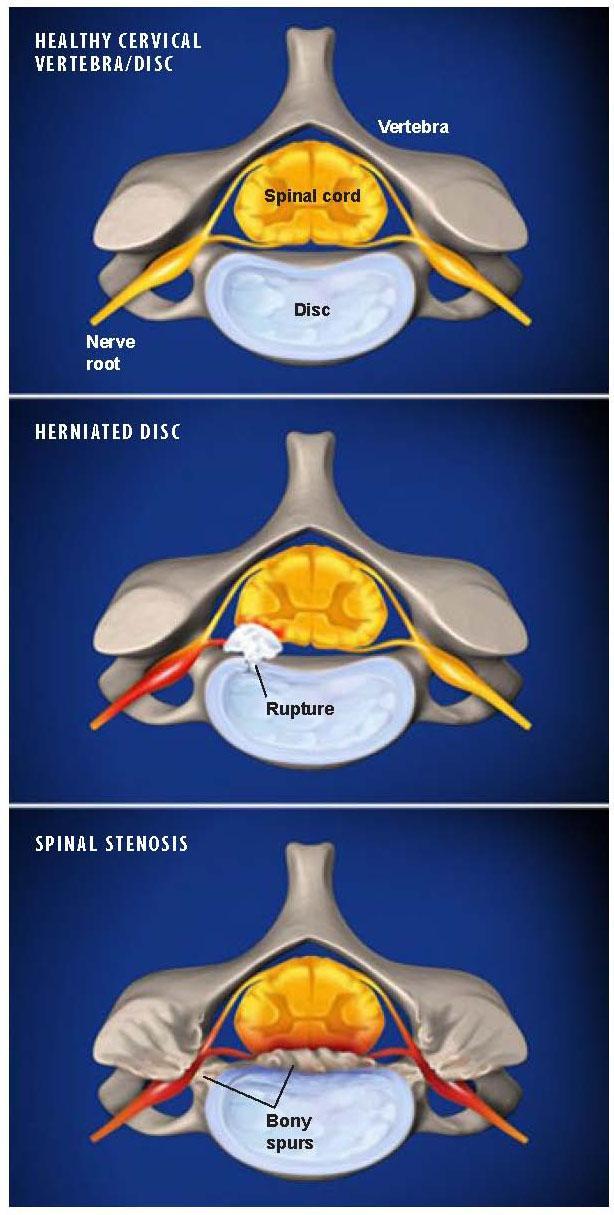 Cervical Radiculopathy Treatments Plano Tx Advanced Spine Center