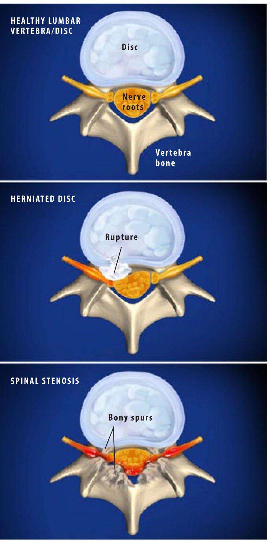 Sciatica  DISC Spine Institute TX