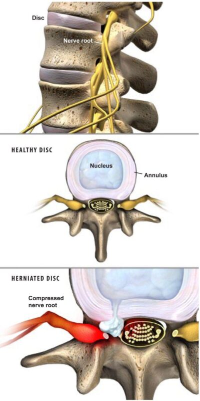 Herniated Disc Treatment Plano Tx Advanced Spine Center