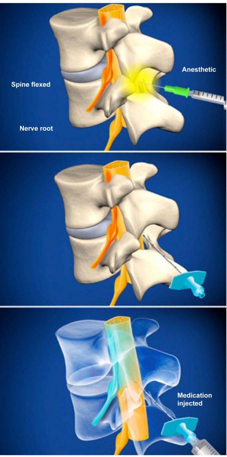 Lumbar Epidural Steroid Injection Without Contrast | Advanced Spine Center