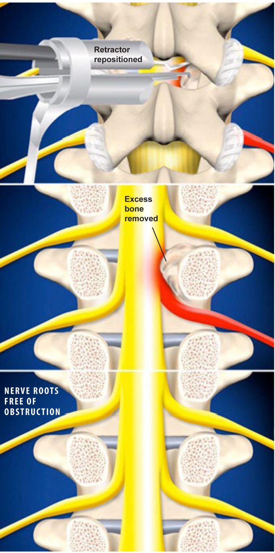 Minimally Invasive Lumbar Microdecompression Plano Tx Asc