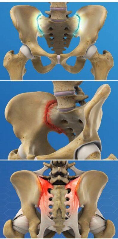 sacroiliac joint pain treatment plano