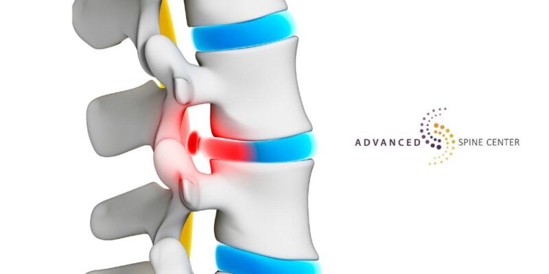 cervical radiculopathy treatments plano tx