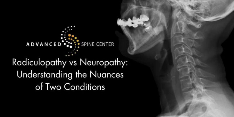 radiculopathy vs neuropathy