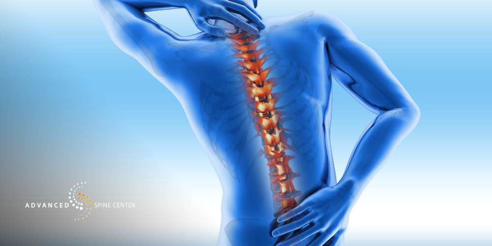 severe spinal stenosis